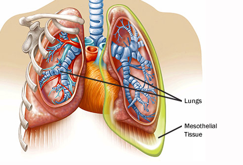 A Brief Overview Of Mesothelioma