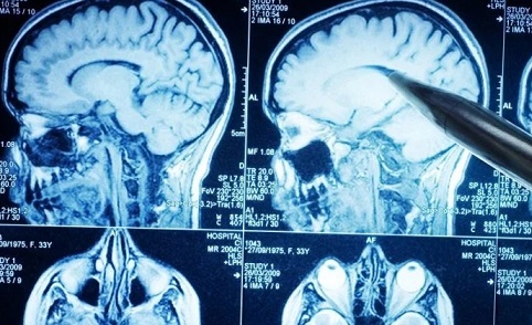 Brain Injury Attorneys Serving Head Injury Clients in Texas & Nationwide
