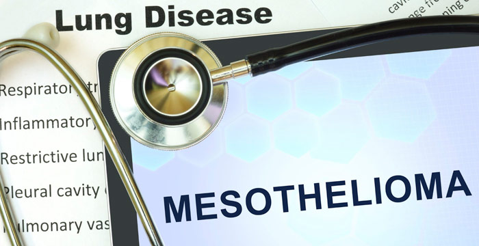 Your Rights and Mesothelioma